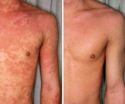Eczema Relief Cream Skin Treatment Soothing Cream for Irritated Skin