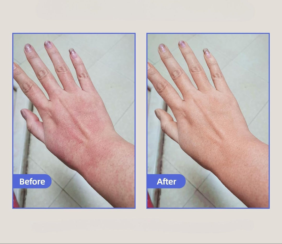 Eczema Relief Cream Skin Treatment Soothing Cream for Irritated Skin