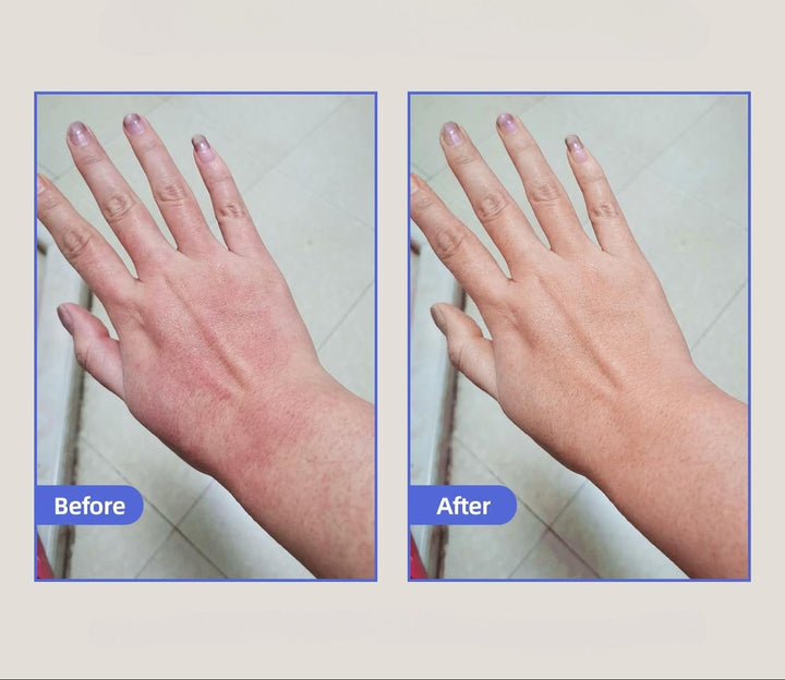 Eczema Relief Cream Skin Treatment Soothing Cream for Irritated Skin