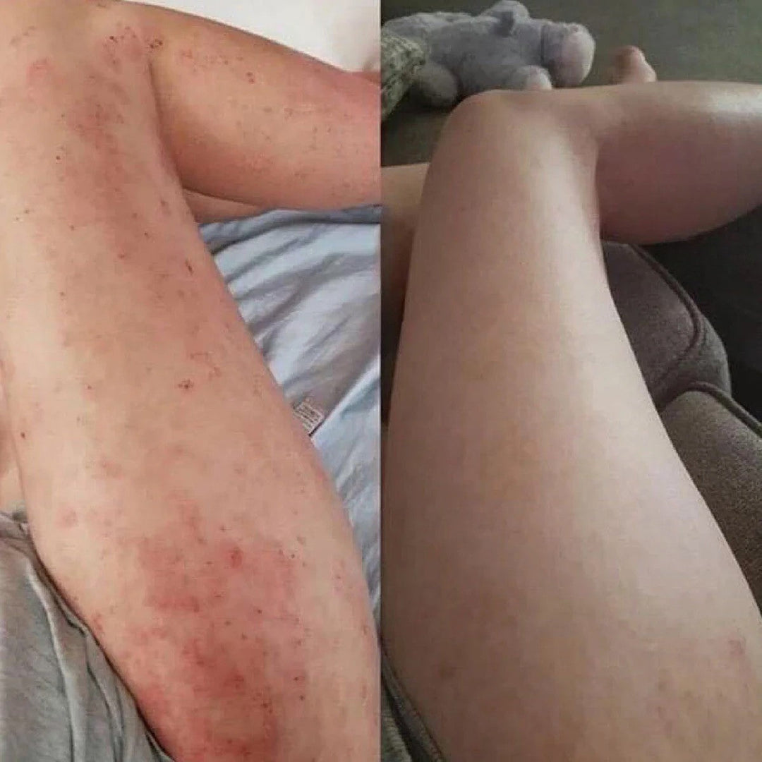 Eczema Relief Cream Skin Treatment Soothing Cream for Irritated Skin