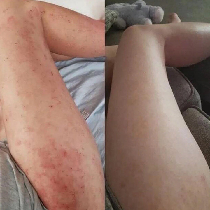 Eczema Relief Cream Skin Treatment Soothing Cream for Irritated Skin